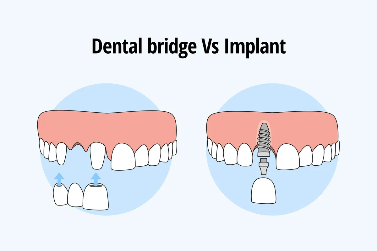 Implantaten of Brug: Wat Is de Beste Keuze?