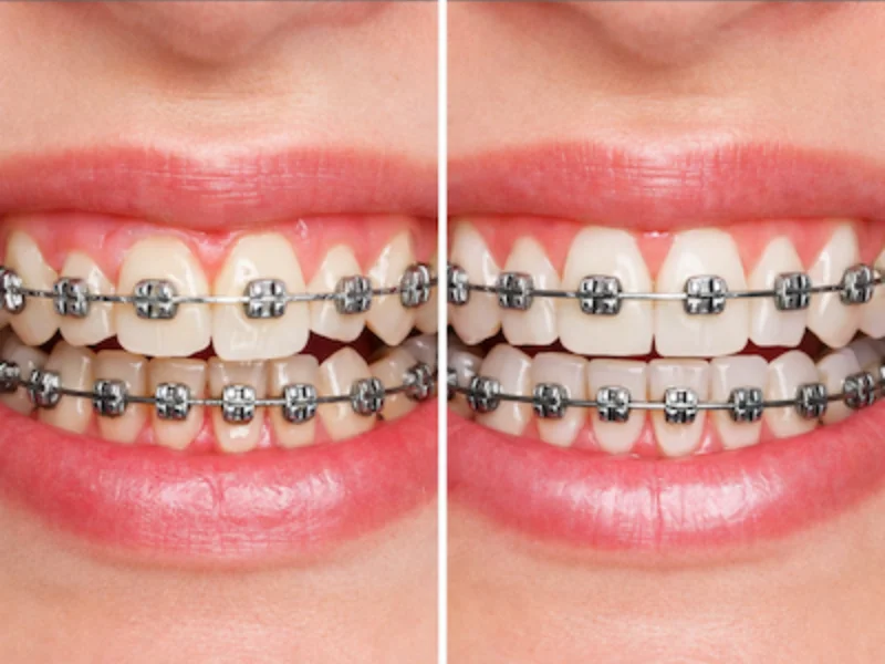 Orthodontie & Beugels
